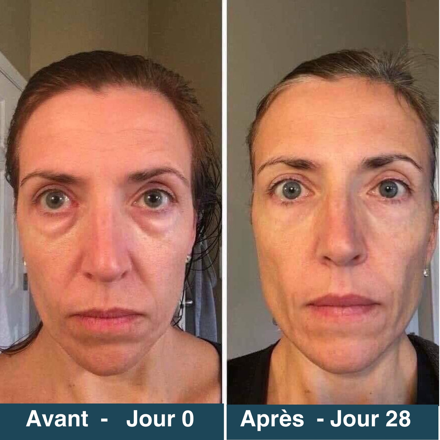 Avant après patch micro-aiguilles yeux cernes et poches résultat 1 mois